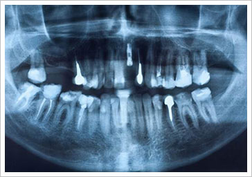 植牙後應注意事項