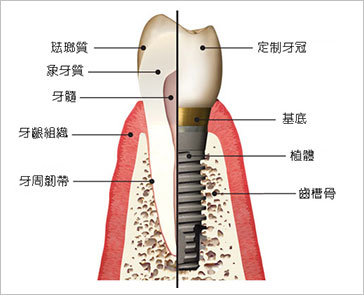 人工植牙如何進行？