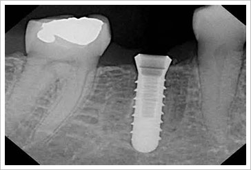 人工植牙如何進行？